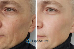 How to Fight Aging Symptoms 3 Fight Aging Symptoms Abbots Langley With HIFU and Morpheus8 Today!