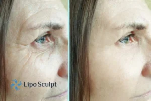 How to Fight Aging Symptoms 2 Do you want to Fight Aging Symptoms Abbots Langley? Contact Lipo Sculpt today!