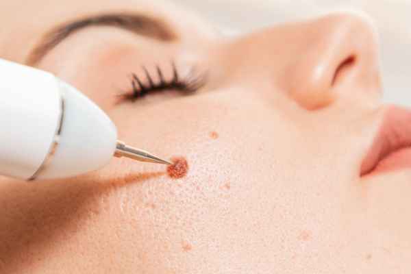 CryoPen: 5 Skin Concerns It May Be Used to Treat 3 What actually happens during a CryoPen treatment Abbots Langley?