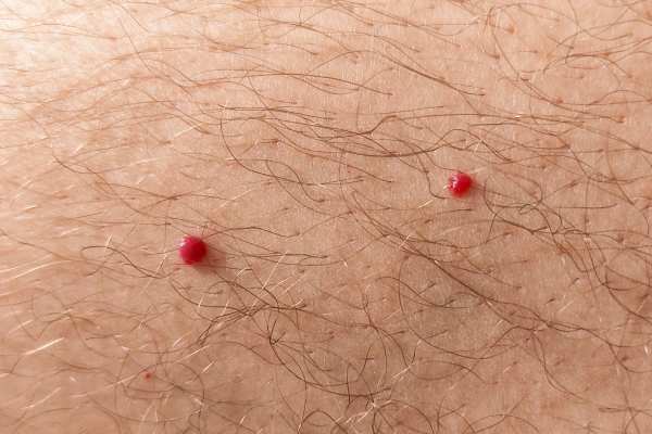CryoPen: 5 Skin Concerns It May Be Used to Treat 2 cherry angioma removal Abbots Langley