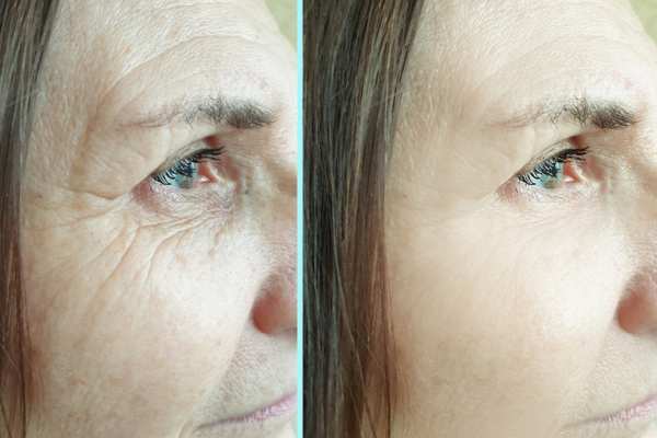 Why Do People Choose HIFU for a Non-Surgical Facelift? 4 How long can HIFU results last Abbots Langley?