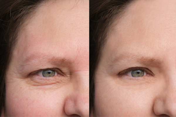 HIFU vs Botulinum Toxin: Understanding the Differences 4 How long do HIFU results last Abbots Langley?