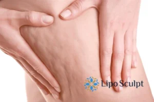 CoolSculpting for Legs: The Innovative Approach to Redefining Your Legs 5 Start your journey today book your coolsculpting treatment Abbots Langley online today!